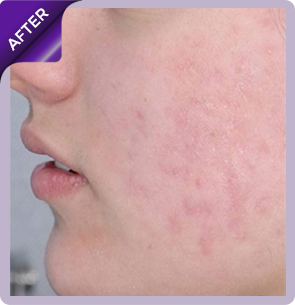 After acne treatment