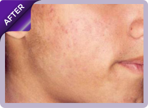 acne treatment after
