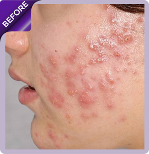Acne Treatmen Before