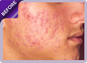 acne treatment before