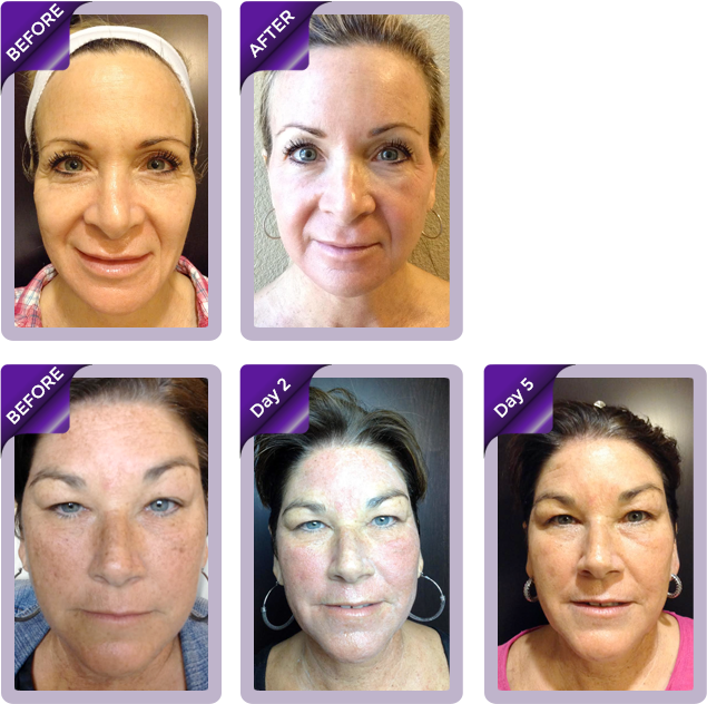 before-after