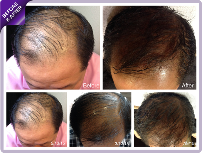 ha_regrowth