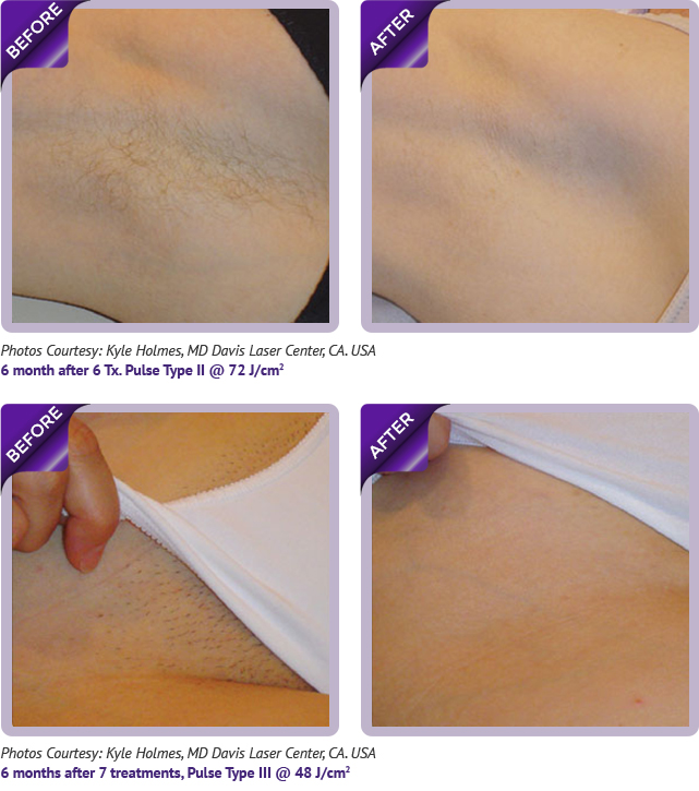 Pain Free Laser Hair Removal Treatment in Scottsdale Arizona