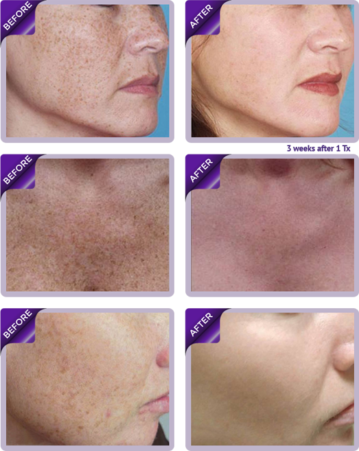 photoficial_before&after