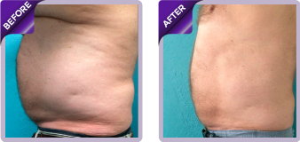 Venus After Before images