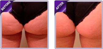 Venus After Before images