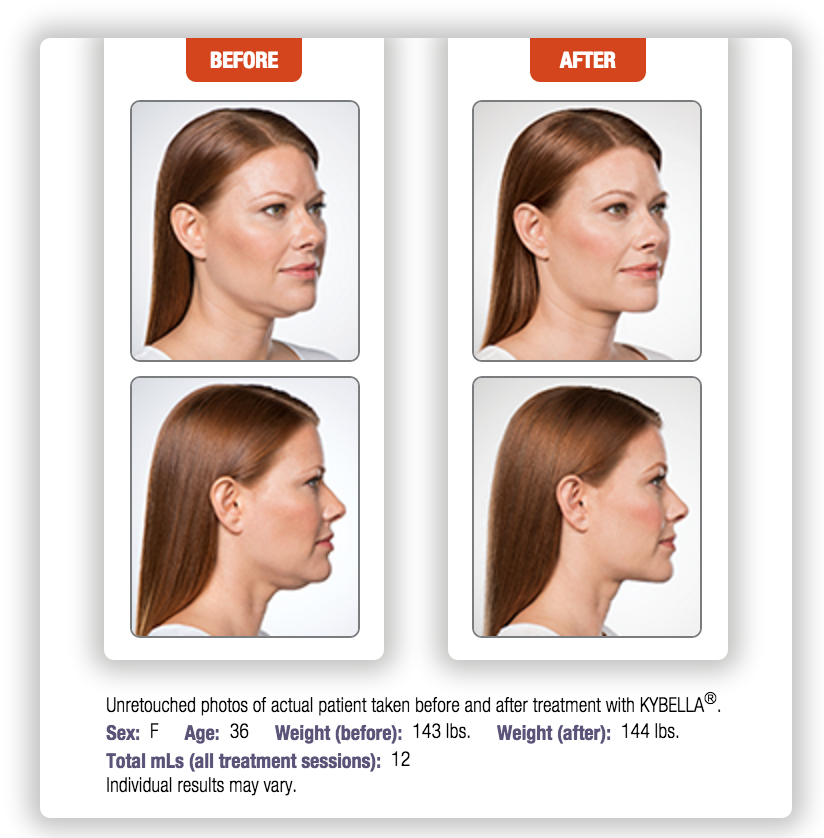kybella special